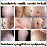 Gambar STRECHMARK CREAM Krim Stretch Mark Pascamelahirkan PENGHILANG dari Marjeta Nadine undefined 2 Tokopedia