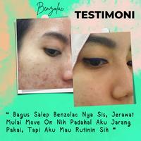 Gambar Cream Jerawat Racikan Dokter Obat Penghilang Jerawat Menahun Benzolac dari shintia. undefined 5 Tokopedia