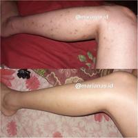 Gambar PENGHILANG BEKAS LUKA AMPUH ! SCAR PEELING dari siskaevarista undefined 4 Tokopedia