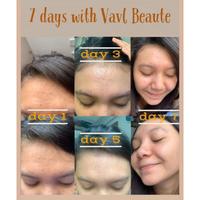 Gambar Dijual VAVL PAKET BYE ACNE Free pouch gift Diskon dari panji shop- undefined 2 Tokopedia