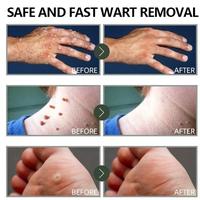 Gambar PENGHILANG TAHI LALAT DI WAJAH PENGHILANG KUTIL DI LEHER WART REMOVAL TAG RECEDE PENGHILANG KUTIL DAN TAHI LALAT OBAT KUTIL PALING AMPUH SKIN TAG REMOVER BEE VENOM TREATMENT SPRAY - 1PC=20ml dari ayam penyet dalq undefined 4 Tokopedia