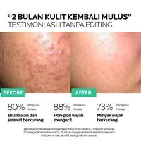 Gambar Cream Anti jerawat Zhenxiu Acne Menyamarkan bekas jerawat 20g dari Fit n Well undefined 2 Tokopedia