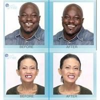 Gambar Gigi Palsu Instan Tempel Instant Smile Temporary Tooth Kit dari RISKANI OYISAM undefined 5 Tokopedia