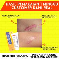 Gambar PENGHILANG BEKAS LUKA BAKAR SALEP GATAL MEILIBAHENLING NUTRIVE CREAM 40ml PENGHILANG KELOID ORIGINAL BPOM dari gunastapwik undefined 3 Tokopedia