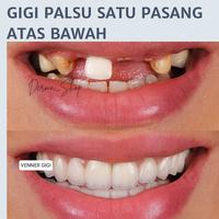 Gambar Paket gigi palsu atas bawah Gigi palsu permanen kuat tahan lama ori Gigi palsu lepas pasang 1set orang dewasa Gigi palsu atas bawah Gigi palsu penutup ompong lepas pasang Gigi palsu lepas pasang 1set orang dewasa Gigi palsu yang lagi viral di tik tok dari BERKAH BUSANANYA undefined 1 Tokopedia