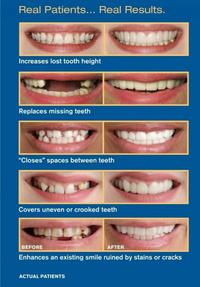 Gambar Gigi Palsu Atas Bawah Snap on Smile Flex Denture Cover Teeth Veneers dari BERKAH BUSANANYA undefined 5 Tokopedia