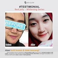 Gambar Paket Wajah Acne Ultimate Luminous Series free bonus pouch dari Tokoneijo undefined 5 Tokopedia
