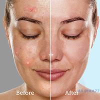 Gambar face skin care pore prep tool stainless steel skin spatula acne popper pimple extractor blackhead remover facial deep cleansing dari fathfarm undefined 2 Tokopedia