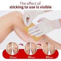 Gambar koyo krim salep herbal penghilang varises herbal varicose veins patch ointment dari Brasia Home undefined 3 Tokopedia