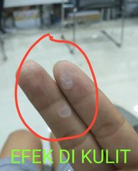 Gambar Momokun Kutil.Go TCA 90% untuk Kutil, Kondiloma, Jengger Ayam Skin tag dari momokun undefined 2 Tokopedia