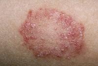 Gambar kode0-2| krim/ cream kulit atasi kurap (produk kecantikan) dari Klinik Luka Mandiri undefined 1 Tokopedia