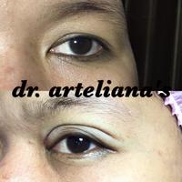 Gambar sulam lipatan mata dari dr.arteliana undefined 1 Tokopedia