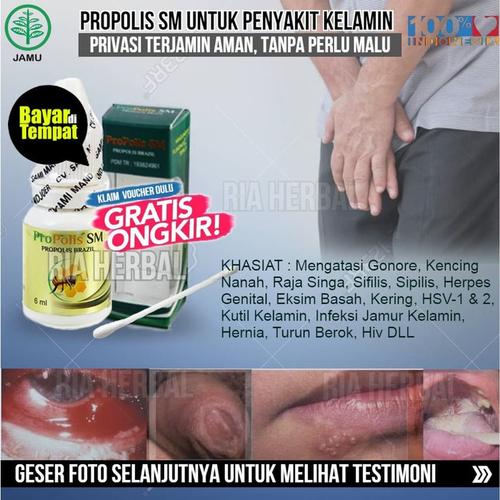 Jual Obat Penghilang Gatal Anus Akibat Wasir Ambeien Yang Terbukti Alami Jakarta Barat Toko Ria Herbal Tokopedia