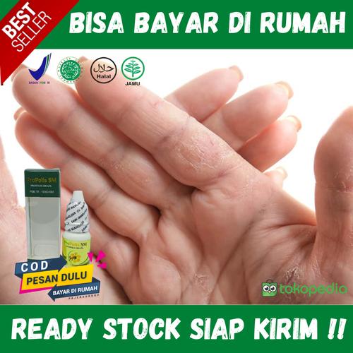 Jual Obat Salep Kulit Jari Kering Pecah Pecah Bersisik Mengelupas Gatal Kab Bekasi Rairaka Herbal Tokopedia