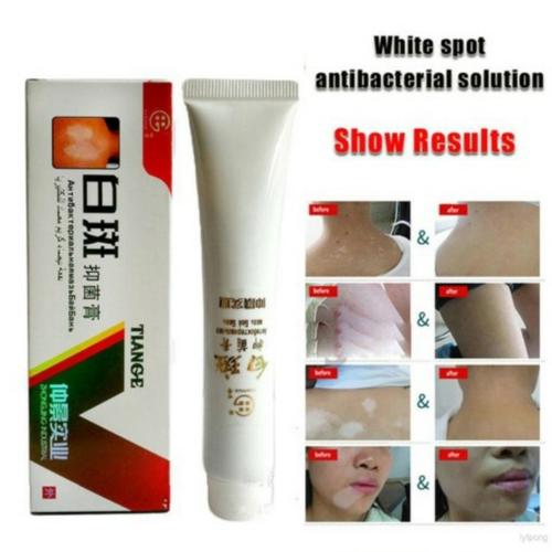Foto Produk Obat Salep Vitiligo Tiange Cream Psolaren Penyakit Kulit Belang Putih dari syihabvadia