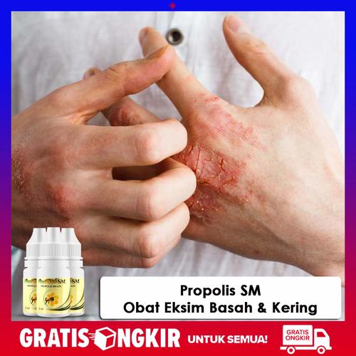 Foto Produk Obat Eksim,Obat Oles Eksim Kering Menahun, Exim Basah - Propolis SM dari Safitri Herbal