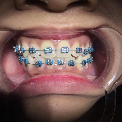 Jual Promo Pemasangan Kawat Gigi Rahang Atas Dan Bawah Kab Tangerang Fortune Dental Care Jual Promo Pemasangan Kawat Gigi Rahang Atas Dan Bawah Kab Tangerang Fortune Dental Care