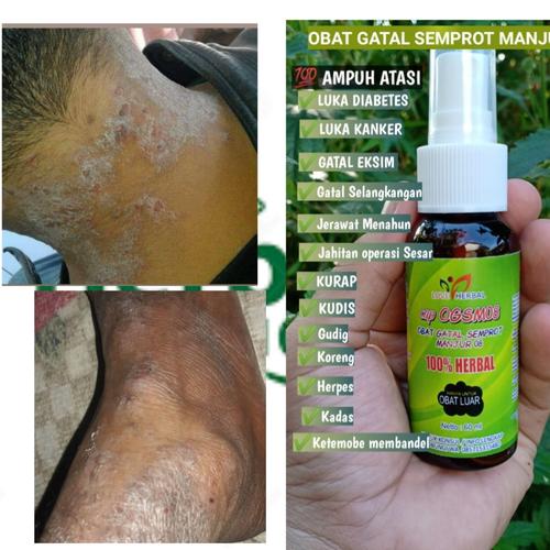 Foto Produk obat eksim basah kering ampuh separah apapun sembuh dari OBAT HERBAL EKSIM