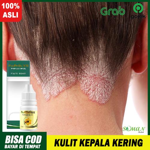 Jual Obat Psoriasis Kepala Kulit Kepala Kering Bersisik Berkerak Propolis Jakarta Pusat Toko Salman Fauzan Tokopedia
