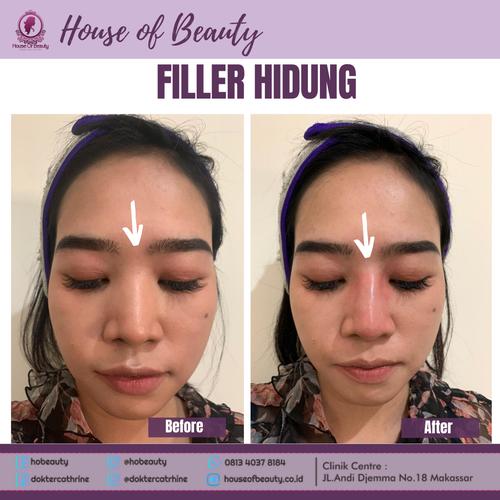 Jual Filler Hidung Memancungkan Hidung Kecantikan Kota Makassar Hobeautymks Tokopedia