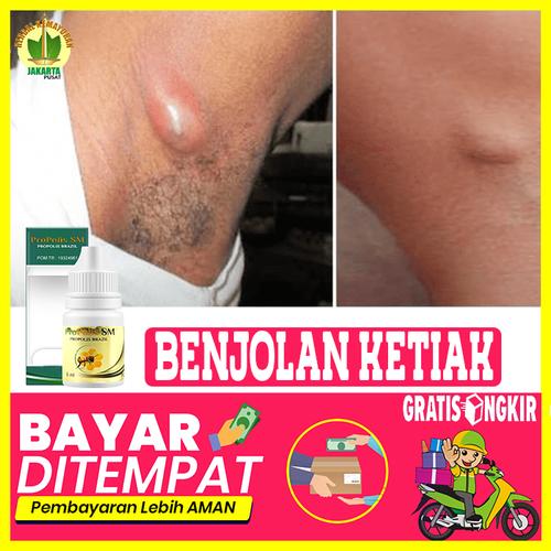 Jual Obat Benjolan Di Ketiak Kaki Leher Tangan Cara Mengobati Herbal Jakarta Pusat Toko Qnc Original Tokopedia