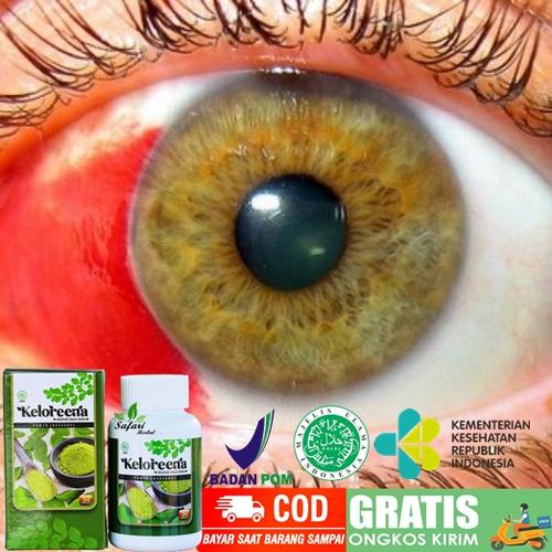 Cara Mengatasi Mata Berdarah Obat Mata Berdarah Di Bagian Putih Herbal Alami Youtube
