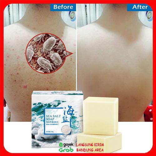 Foto Produk Sabun Jerawat Menghilangkan Jerawat Punggung dan Muka | Sea Salt Soap dari Jibooji
