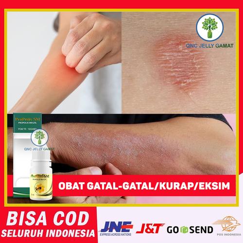 Foto Produk Obat Herbal Eksim Kering - Obat Oles Exim - Obat Eksim basah dari tokorismaherbal