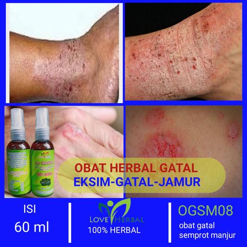 Foto Produk OBAT GATAL KULIT ALAMI PALING AMPUH dari OBAT HERBAL EKSIM