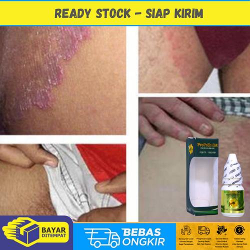 Gambar Obat Herpes Genital, Kutil Kelamin, Gatal Kemaluan - Propolis SM dari Sapnu Herbal Jakarta Jakarta Timur Tokopedia