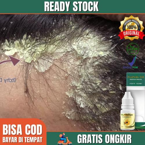 Jual Obat Kulit Seboroik Dermatitis, Tinea Capitis, Cradle Cap
