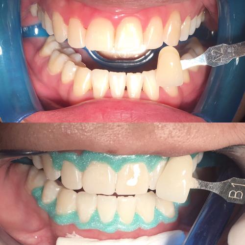 Jual Bleaching / whitening gigi Jakarta Selatan SERAPHIC SMILE