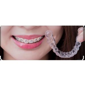 Harga retainer setelah lepas behel