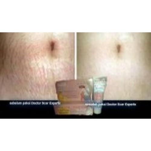 Foto Produk PENGHILANG STRETCHMARK LAOSHIYA Dr. SCAR EXPERT dari Queen'sShop