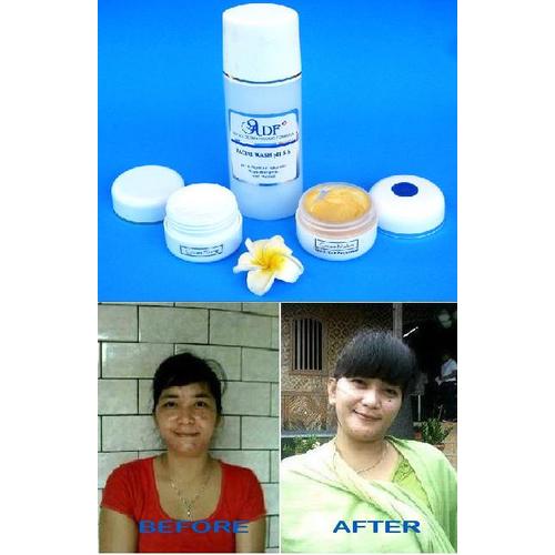 Foto Produk PAKET ANTI ACNE dari Dunia Dandan