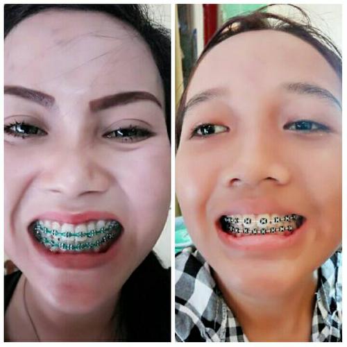 Jual Pasang Behel Standard Ortho Kota Yogyakarta Alfa Dental Yk Jual Pasang Behel Standard Ortho Kota Yogyakarta Alfa Dental Yk