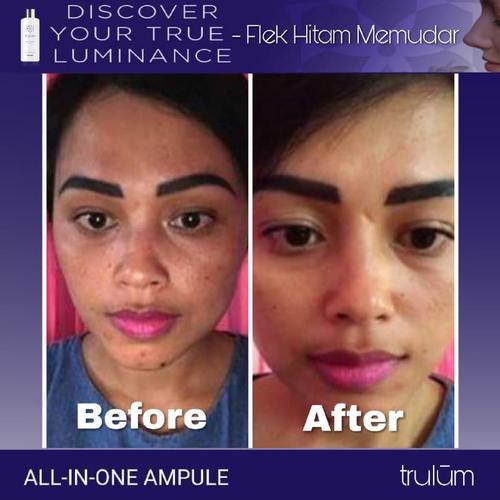 mederma untuk stretch mark