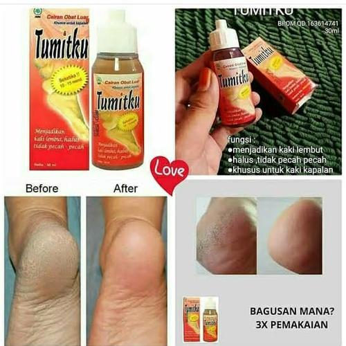 Foto Produk TUMITKU - OBAT HERBAL KAKI KAPALAN /KULIT KAKI PECAH- PECAH dari LM OS