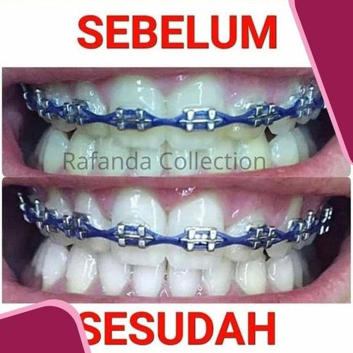 Jual Cara Memutihkan Gigi Berwarna Kuning Cara Memutihkan Karang Gigi Jakarta Pusat Set Pancing Murah Dll Tokopedia