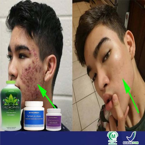Jual Obat Alami Jerawat Dalam Hidung Kab Bekasi Zhafran Game Tokopedia