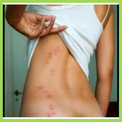 Jual Hot Sabun Gatal Selangkangan Paha Pantat Punggung Leher Dan Obat Eksim Jakarta Selatan Moh91 Grosir Tokopedia