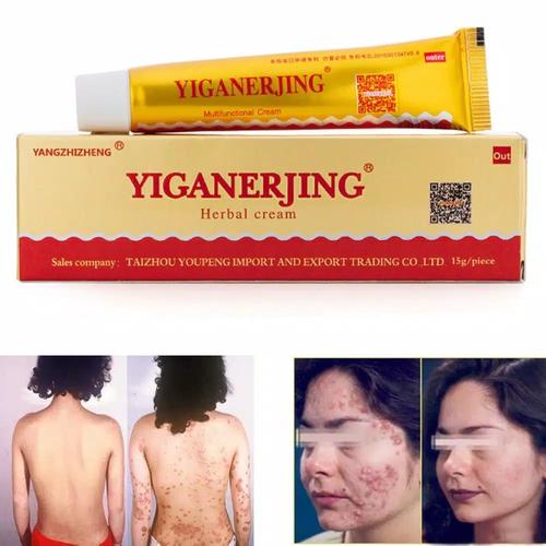 Jual Yiganerjing Obat Penyakit Kulit Psoriasis Eksim Dermatitis Eczema Kota Bekasi Romeoandjuliet Tokopedia