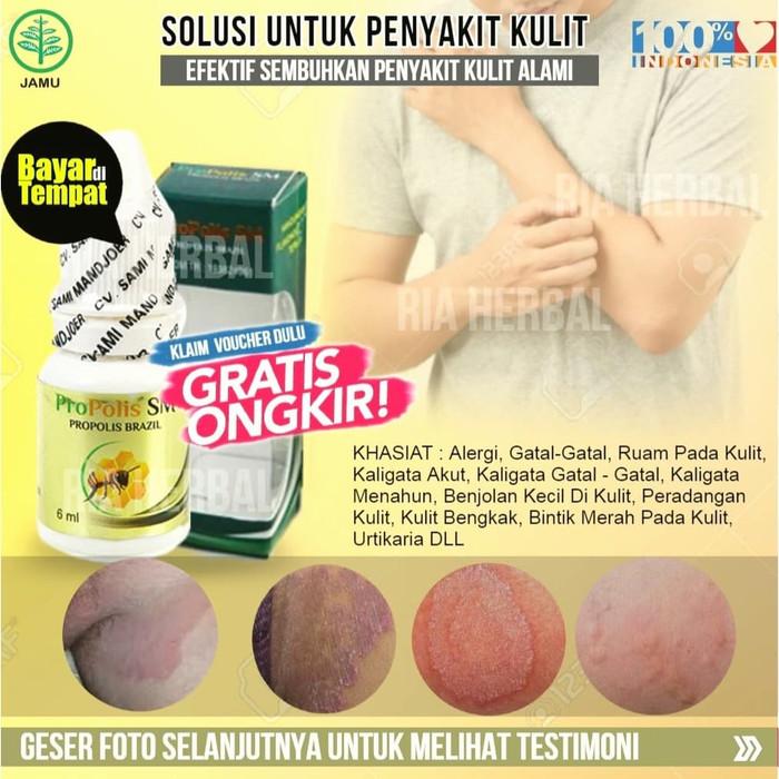 Gambar Obat Borok Di Kepala Tradisional,Pembasmi Jamur Pada Kulit,Bisul,Budug dari Ria Herbal Official undefined Tokopedia