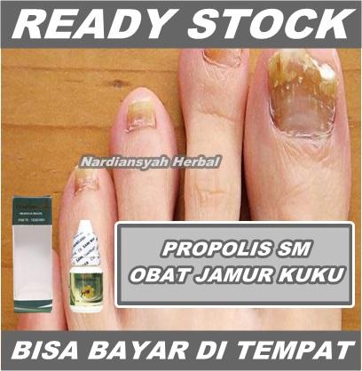 Gambar Obat Jamur Kuku, Infeksi Jamur Kuku, Salep Jamur Kuku di Tangan & Kaki dari azqiaraherbal undefined Tokopedia