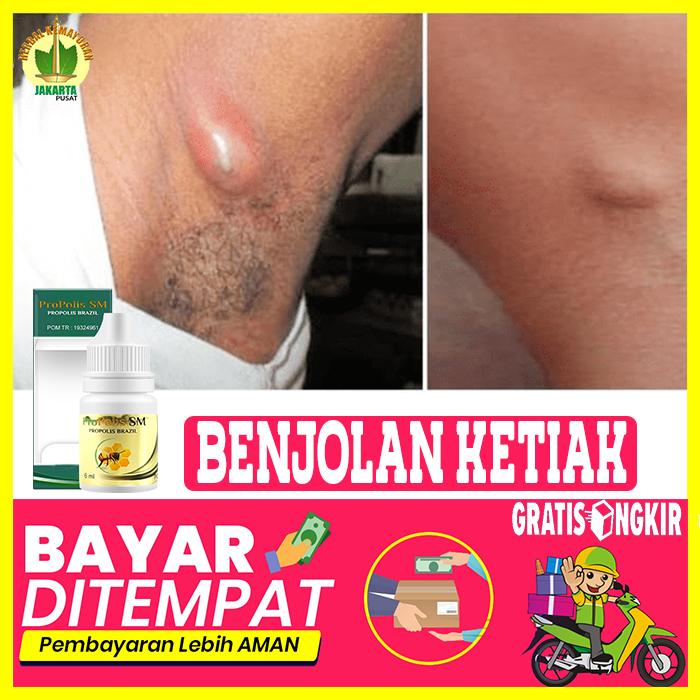 Jual Obat Benjolan Di Ketiak Kelenjar Getah Bening Bisul Bisulan Jakarta Pusat Toko Qnc Original Tokopedia