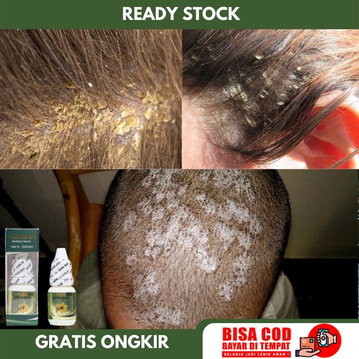 Gambar Propolis SM Obat Ketombe Berkerak & Rambut, Menghilangkan Ketombe Basah & Kering, Gatal di Kepala dari Kurniawati Herbal undefined Tokopedia