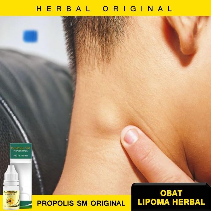 Gambar COD - Obat Oles Herbal Penghancur Benjolan Tiroid Lipoma Gindok Halal dari Jamaludin Herbal undefined Tokopedia