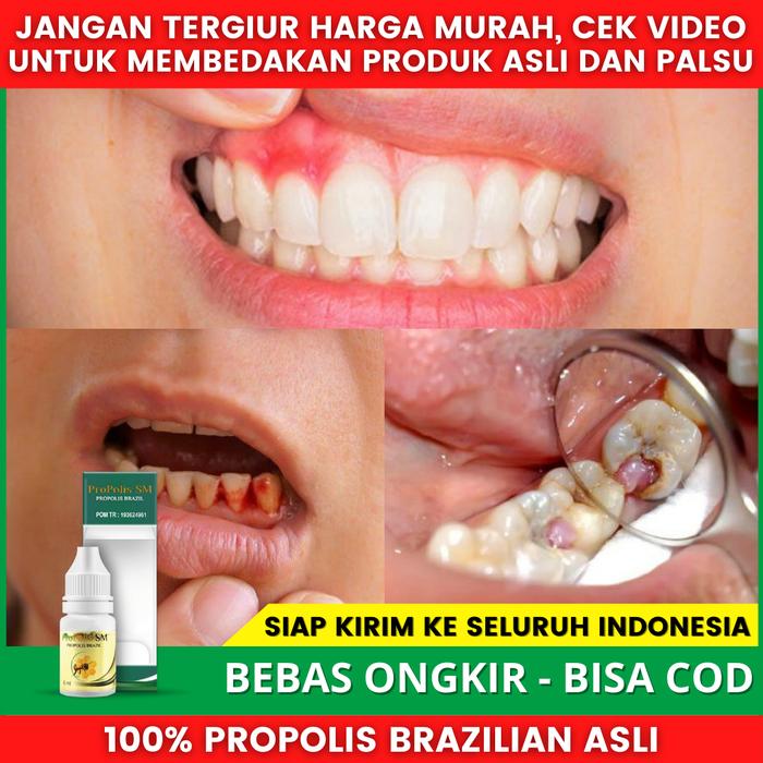 Gambar Obat Radang Gusi Bengkak Karena Gigi Berlubang - Gigi Ngilu - Sakit dari Toko Acep Herbals undefined Tokopedia