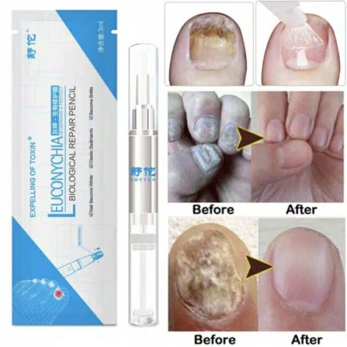 Gambar Salep Kuku Kaki dan Tangan Cantengan Obat Jamur Kuku Leuconychia Cream dari epe store undefined Tokopedia