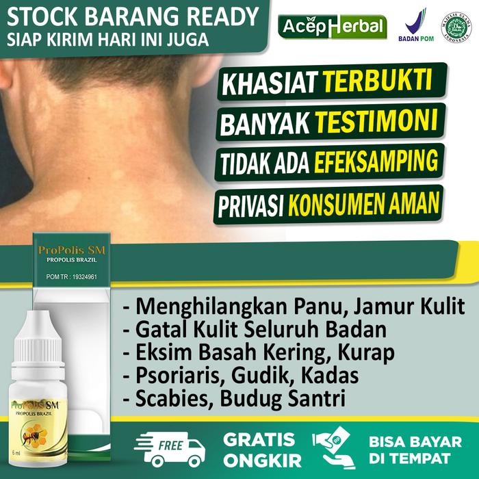 Gambar Obat Jamur Panu Hapuran Gatal Kulit Seluruh Badan Propolis SM dari Toko Acep Herbal Indonesia undefined Tokopedia